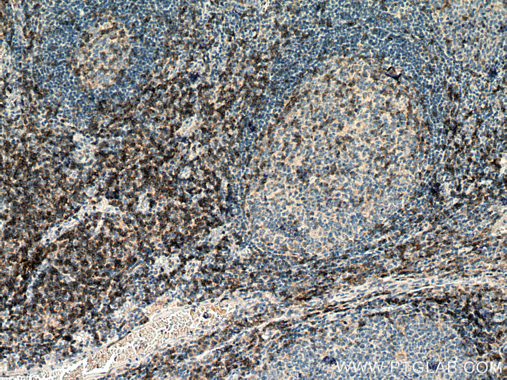 IHC staining of human tonsillitis using 67786-1-Ig