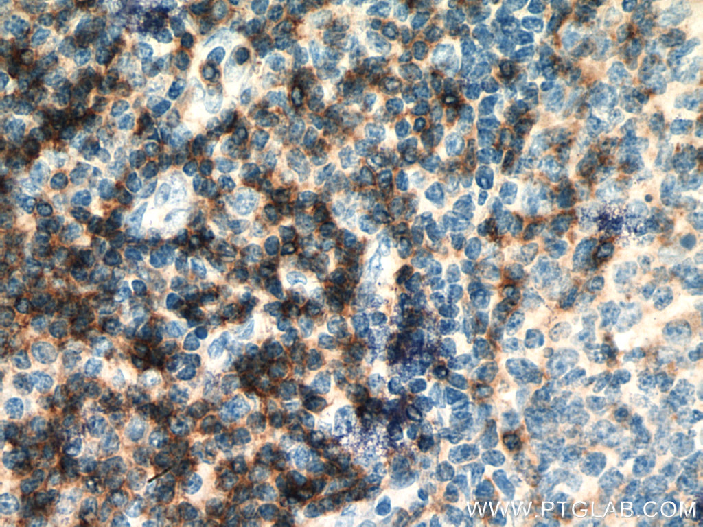 IHC staining of human tonsillitis using 67786-1-Ig