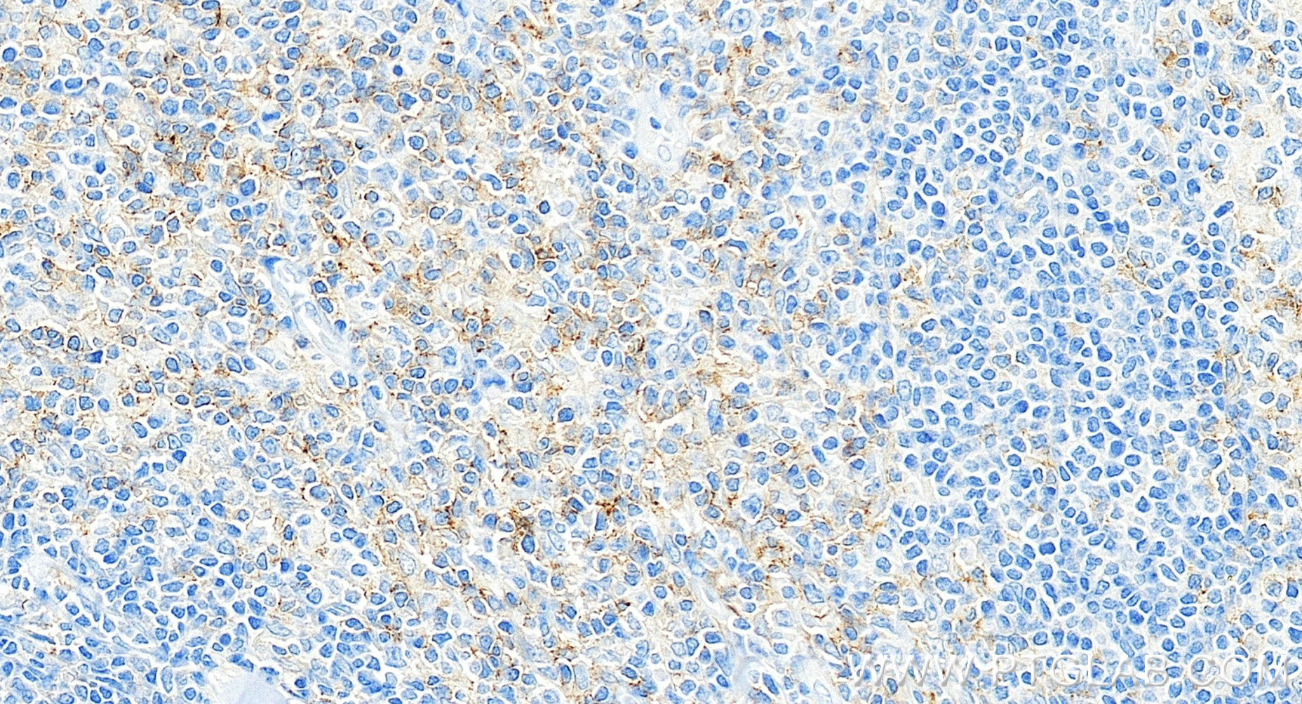 IHC staining of human tonsillitis using 83513-10-RR