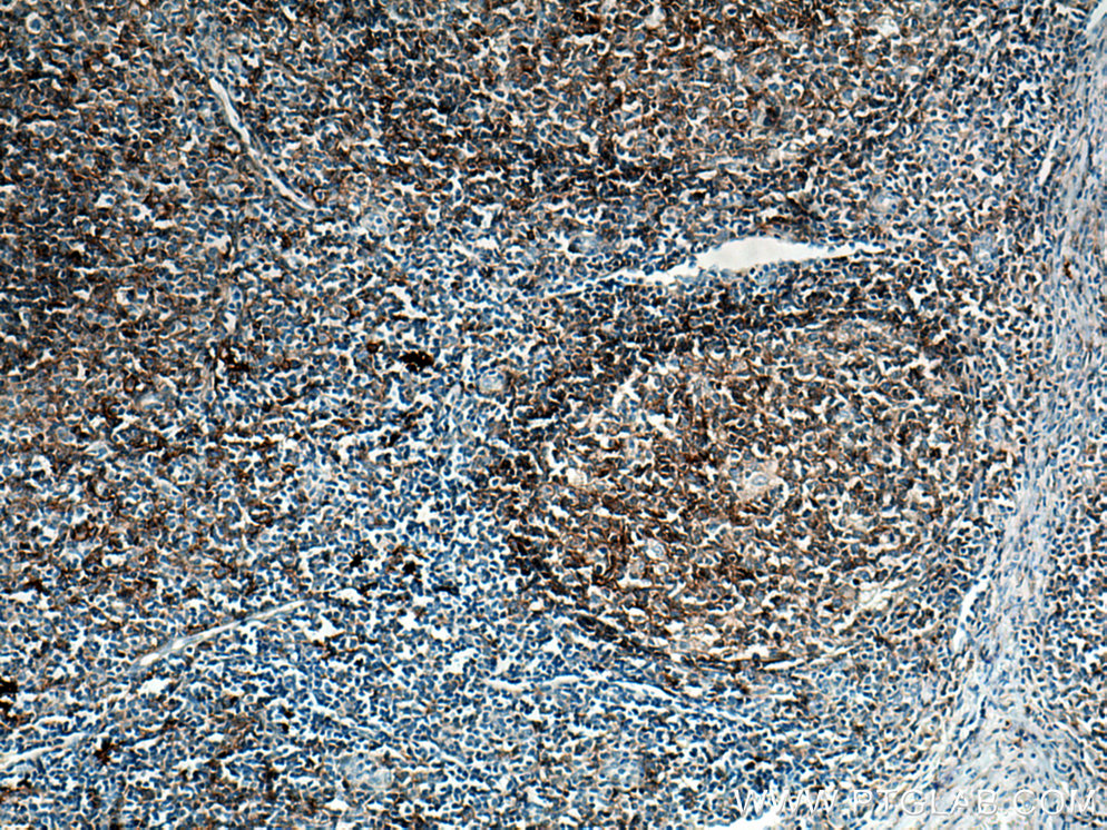 IHC staining of human tonsillitis using 66965-1-Ig