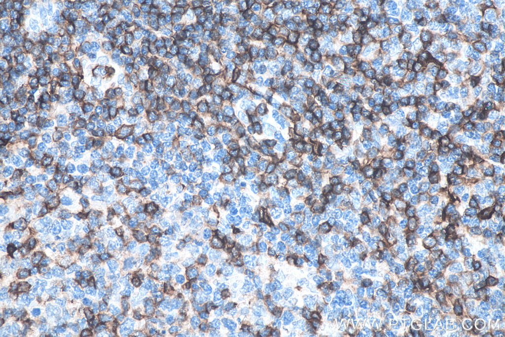 IHC staining of human tonsillitis using 66224-1-Ig