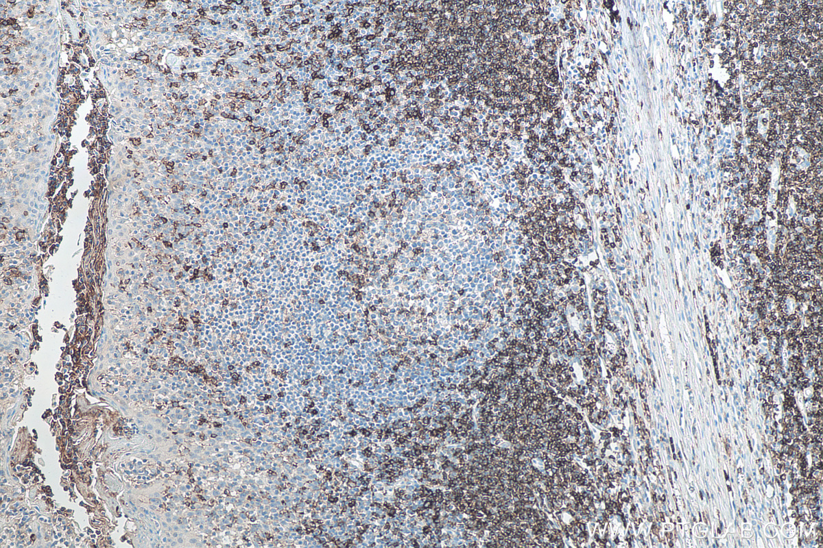 IHC staining of human tonsillitis using 66224-1-Ig