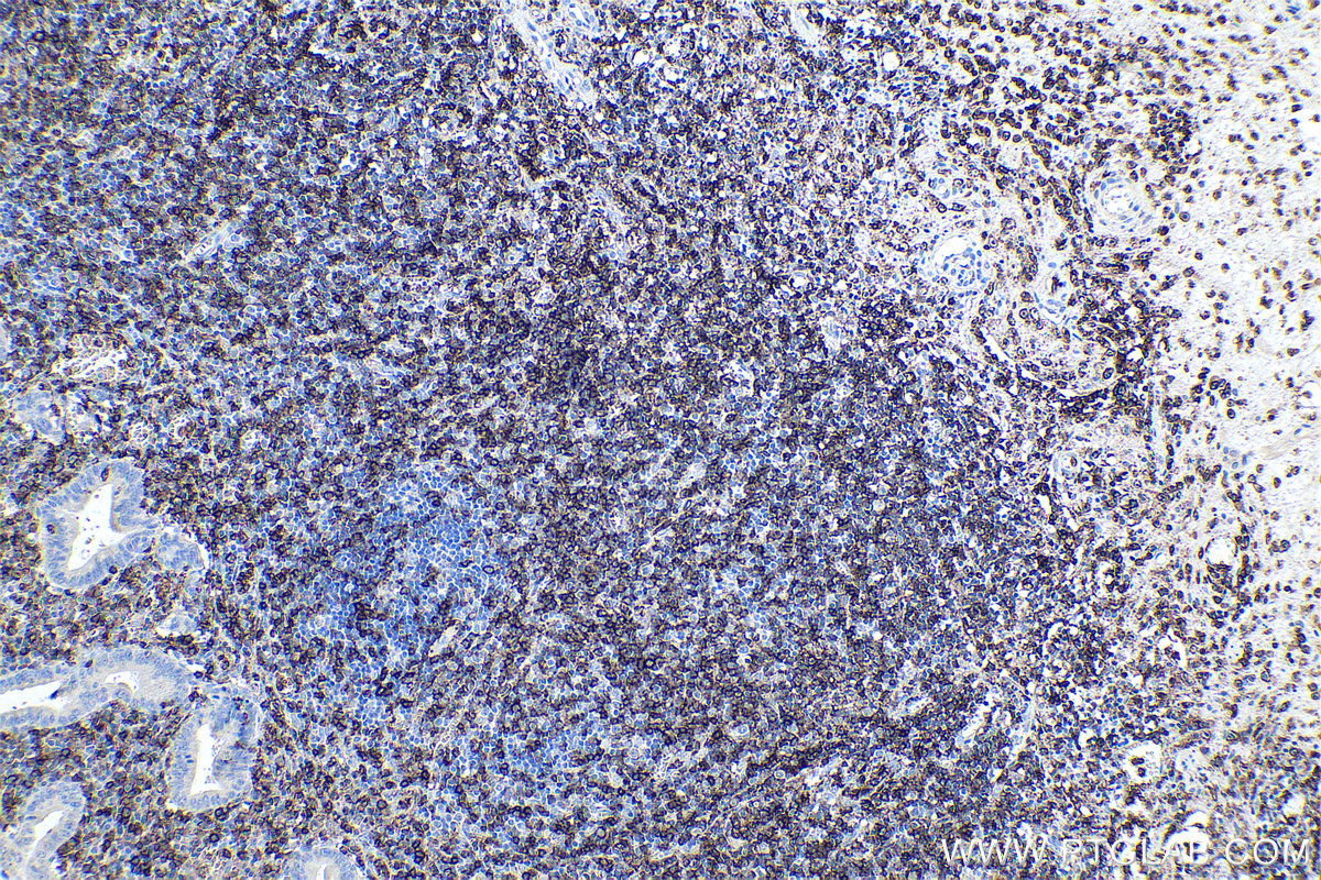 IHC staining of human appendicitis using 66224-1-Ig