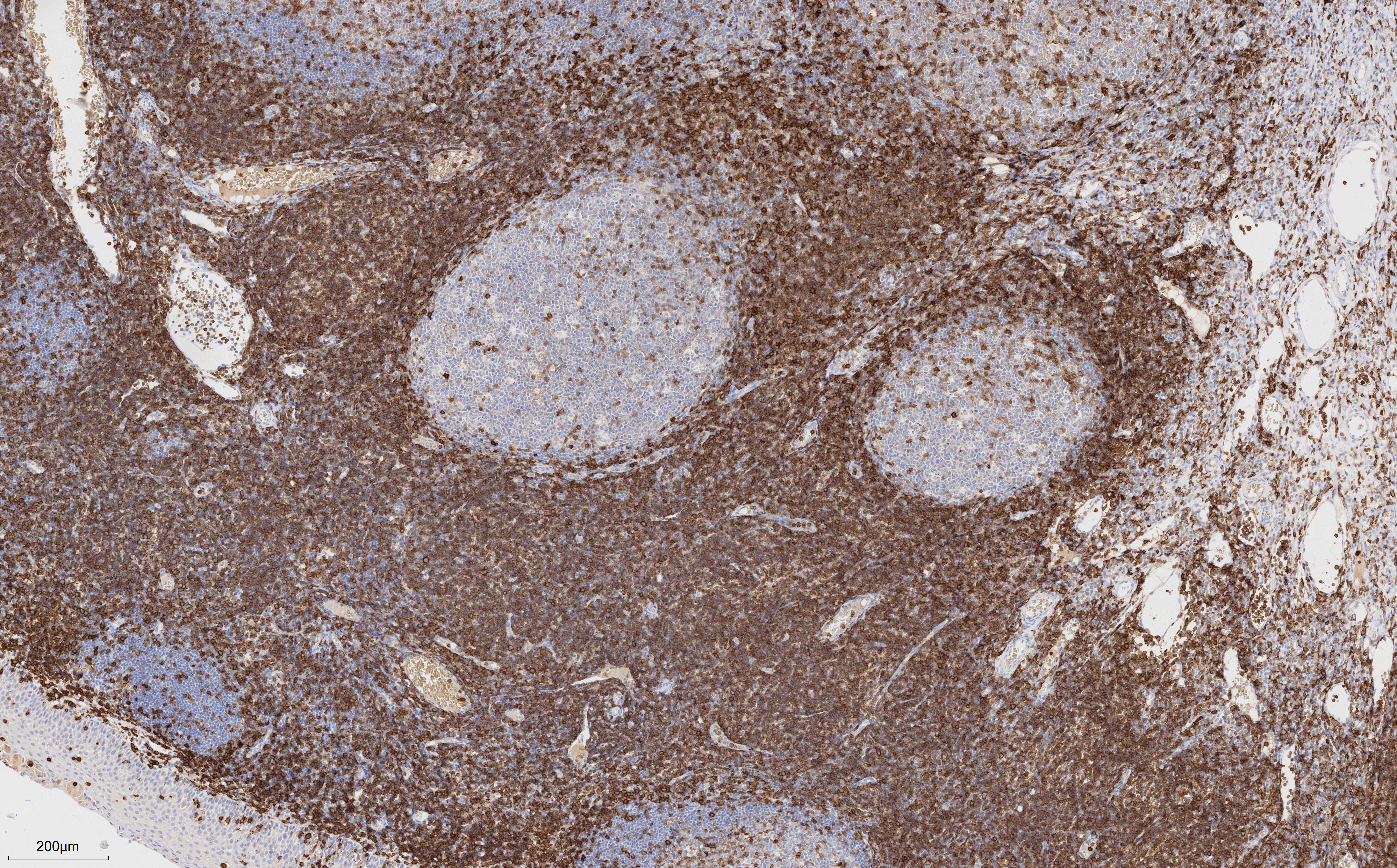 IHC staining of human tonsillitis using 66224-1-Ig