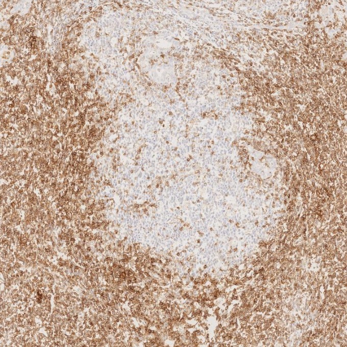IHC staining of human lymphoma using 66224-1-Ig