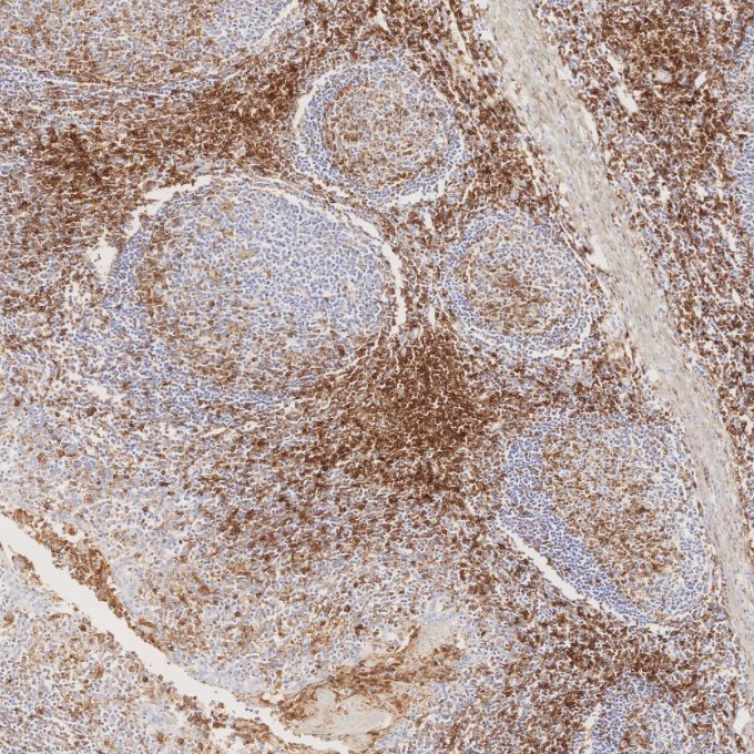 IHC staining of human tonsillitis using 66224-1-Ig
