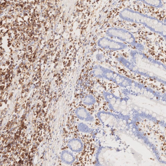 IHC staining of human lymphoma using 66224-1-Ig