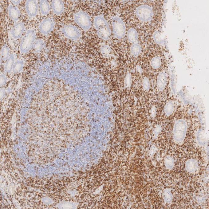 IHC staining of human appendicitis using 66224-1-Ig