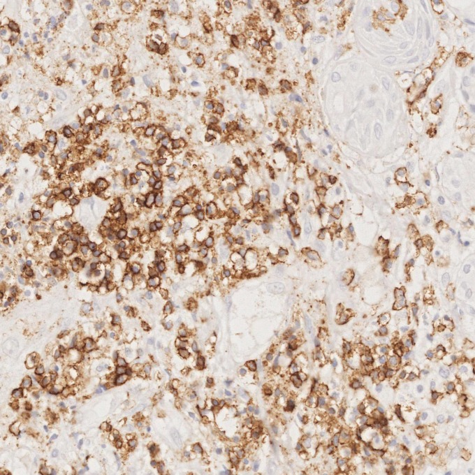 IHC staining of human lymphoma using 66224-1-Ig