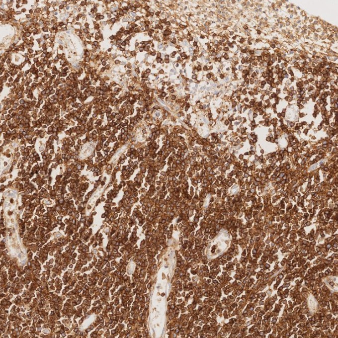 IHC staining of human lymphoma using 66224-1-Ig