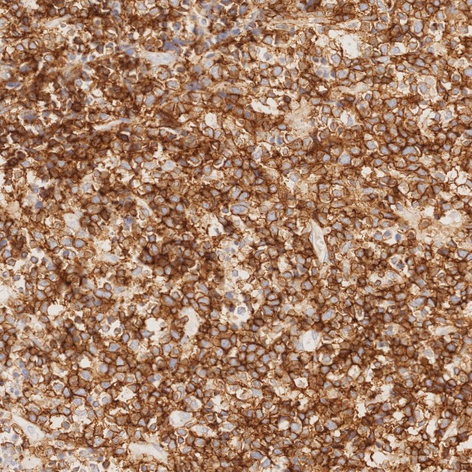 IHC staining of human lymphoma using 66224-1-Ig