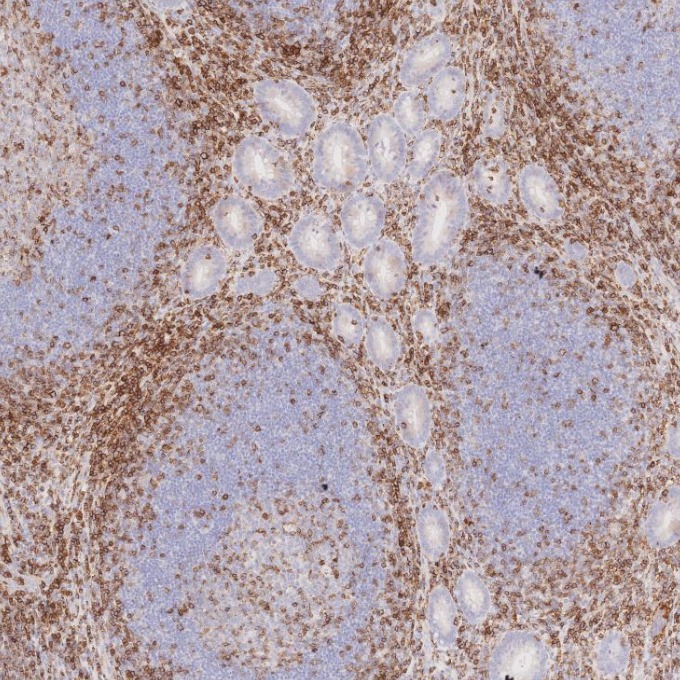 IHC staining of human appendicitis using 66224-1-Ig