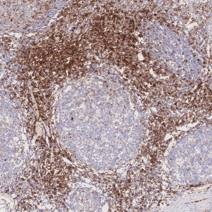 IHC staining of human tonsillitis using 66224-1-Ig