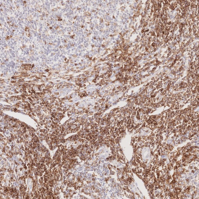 IHC staining of human lymphoma using 66224-1-Ig