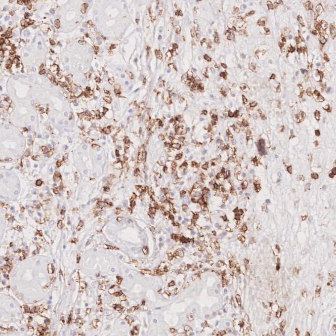 IHC staining of human lymphoma using 66224-1-Ig