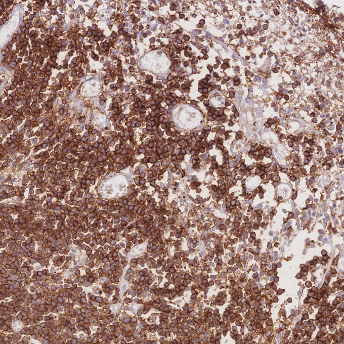 IHC staining of human lymphoma using 66224-1-Ig