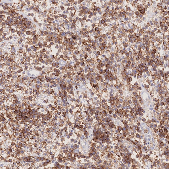 IHC staining of human lymphoma using 66224-1-Ig