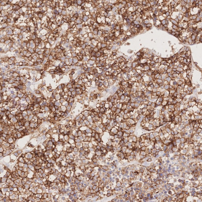 IHC staining of human lymphoma using 66224-1-Ig