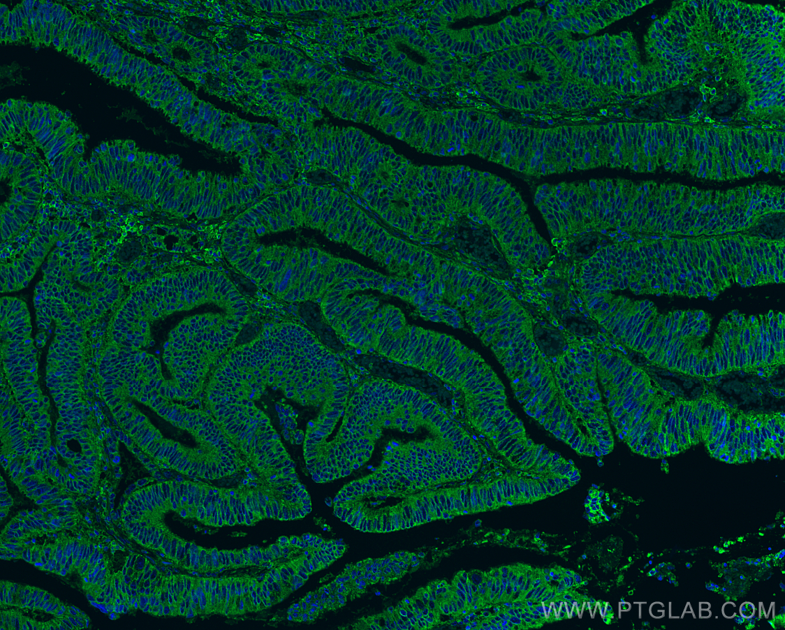 IF Staining of human colon cancer using 15675-1-AP