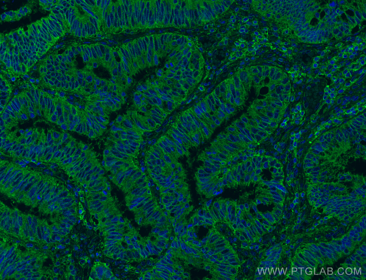 IF Staining of human colon cancer using 15675-1-AP