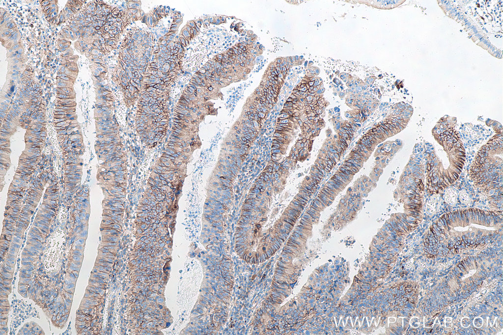 IHC staining of human colon cancer using 60224-1-Ig IHC staining of human colon cancer using 60224-1-Ig