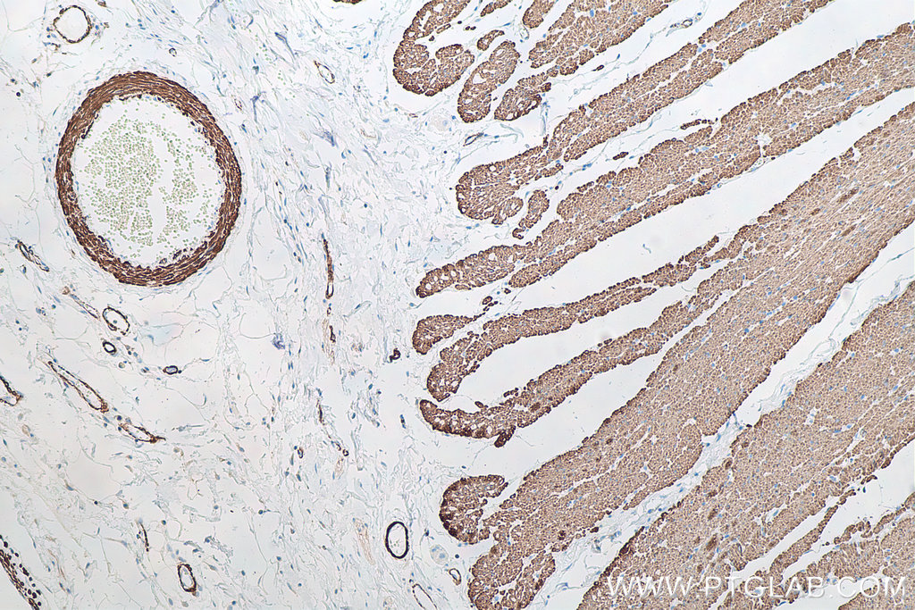 IHC staining of human colon cancer using 60224-1-Ig IHC staining of human colon cancer using 60224-1-Ig