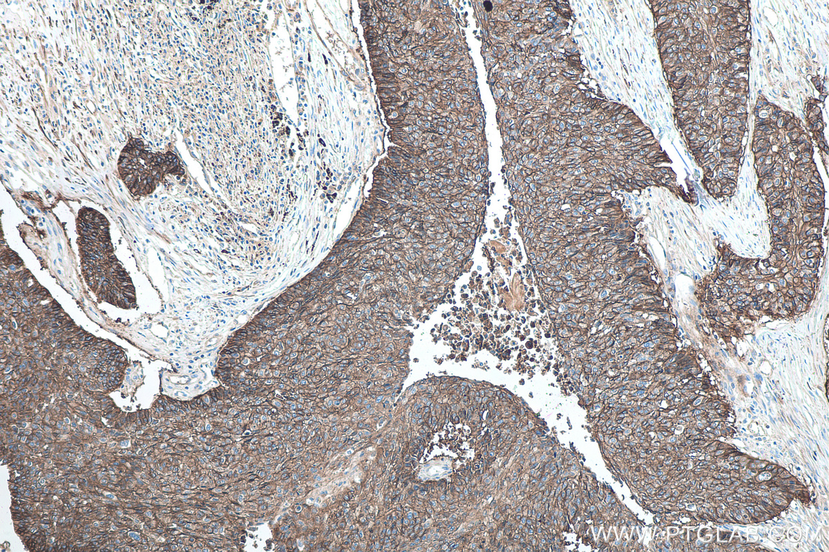 IHC staining of human lung cancer using 60224-1-Ig IHC staining of human lung cancer using 60224-1-Ig