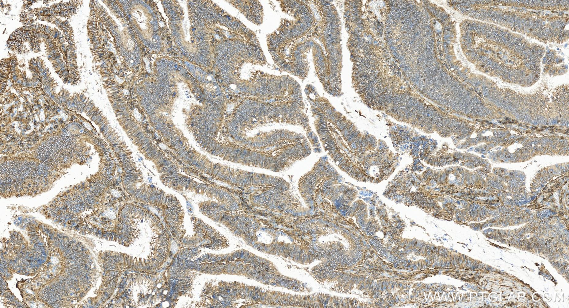IHC staining of human colon cancer using 84854-5-RR (same clone as 84854-5-PBS)