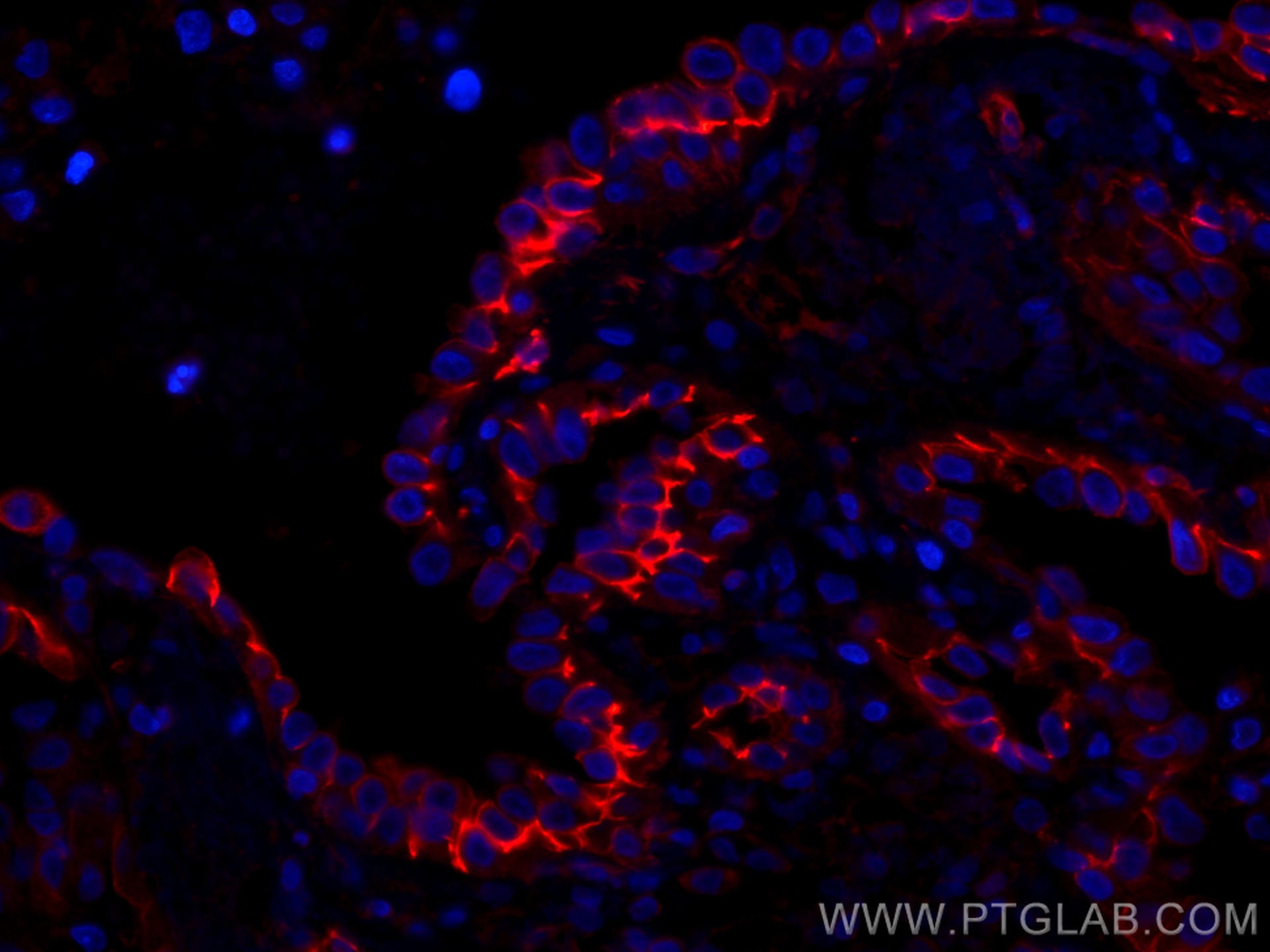 IF Staining of human lung cancer using CL594-60224