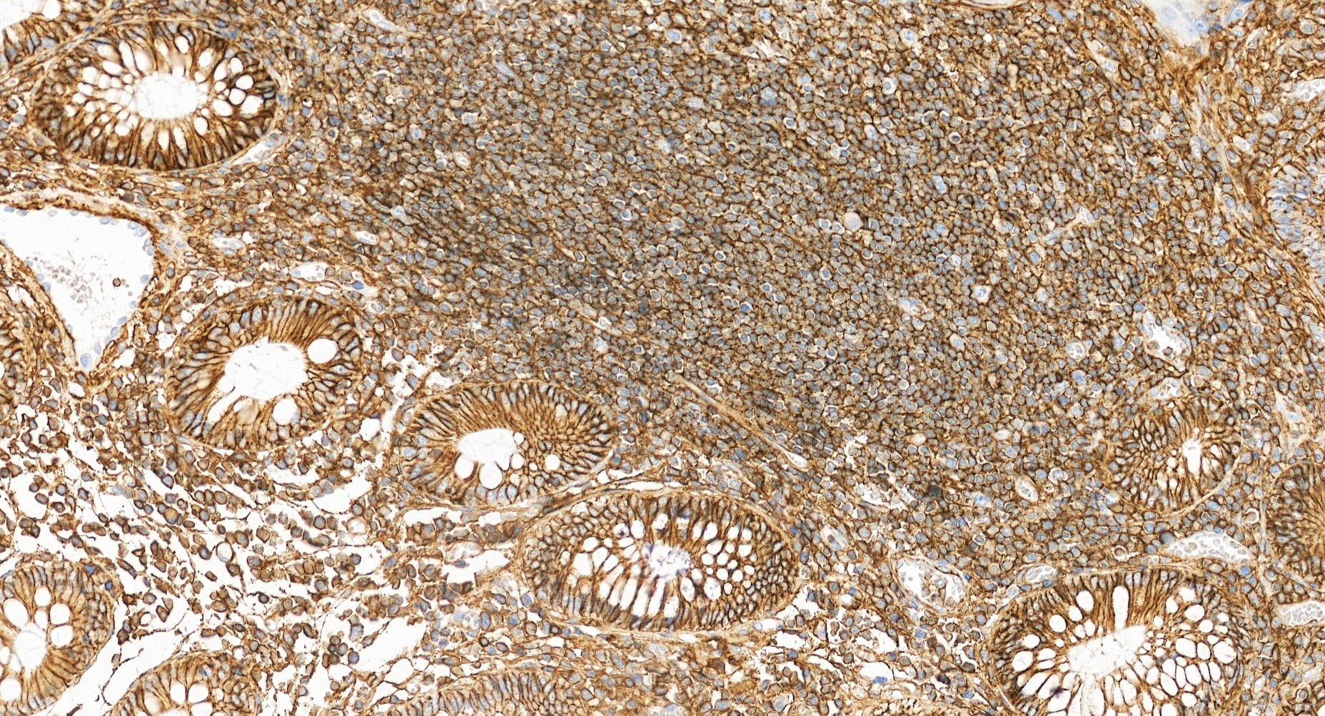 IHC staining of human colon cancer using RMX00065