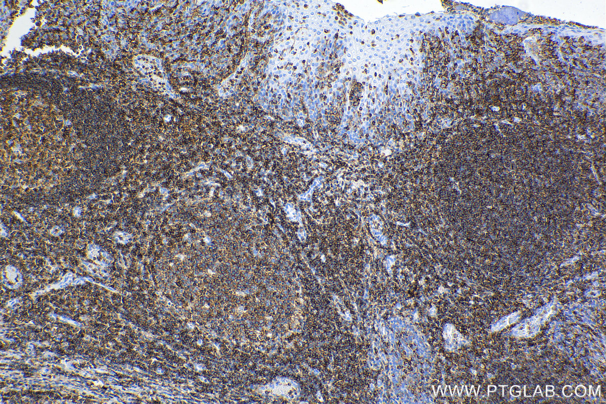 Immunohistochemical analysis of paraffin-embedded human tonsil tissue slide using <a class='green' href='/productredirect?CatalogNo=98117-1-RR' target='_blank'>98117-1-RR</a> (CD45 antibody) at dilution of 1:500 (under 10x lens). Heat mediated antigen retrieval with Tris-EDTA buffer (pH 9.0). This data was developed using the same antibody clone with 98117-1-PBS in a different storage buffer formulation. IHC staining of human tonsil using 98117-1-RR (same clone as 98117-1-PBS)