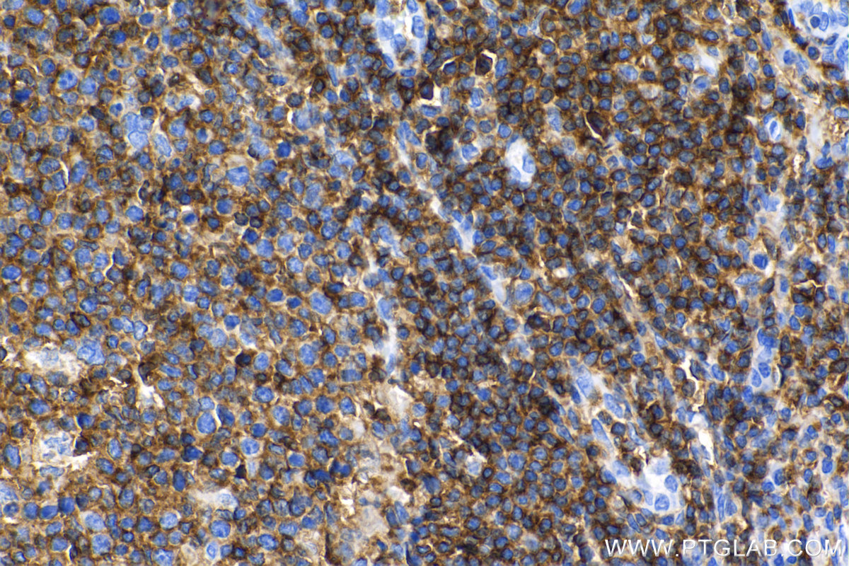 Immunohistochemical analysis of paraffin-embedded human tonsil tissue slide using <a class='green' href='/productredirect?CatalogNo=98117-1-RR' target='_blank'>98117-1-RR</a> (CD45 antibody) at dilution of 1:500 (under 40x lens). Heat mediated antigen retrieval with Tris-EDTA buffer (pH 9.0). This data was developed using the same antibody clone with 98117-1-PBS in a different storage buffer formulation. IHC staining of human tonsil using 98117-1-RR (same clone as 98117-1-PBS)