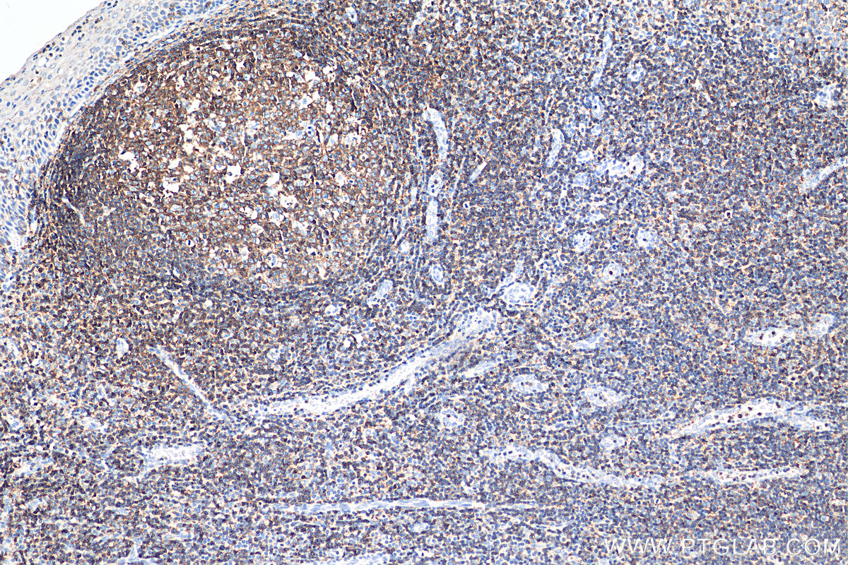 IHC staining of human tonsillitis using 29914-1-AP