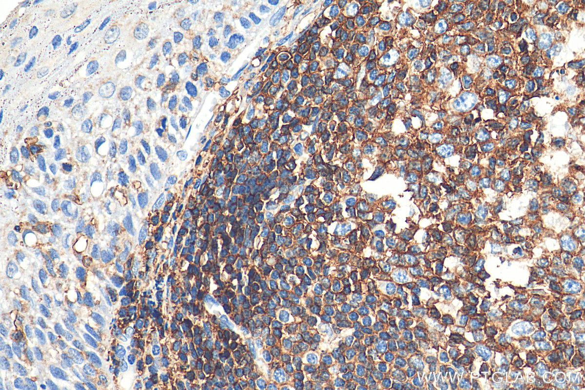 IHC staining of human tonsillitis using 29914-1-AP