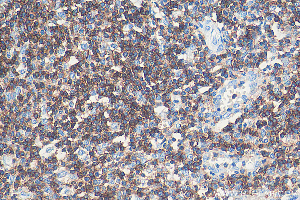 IHC staining of human appendicitis using 60287-1-Ig (same clone as 60287-1-PBS)