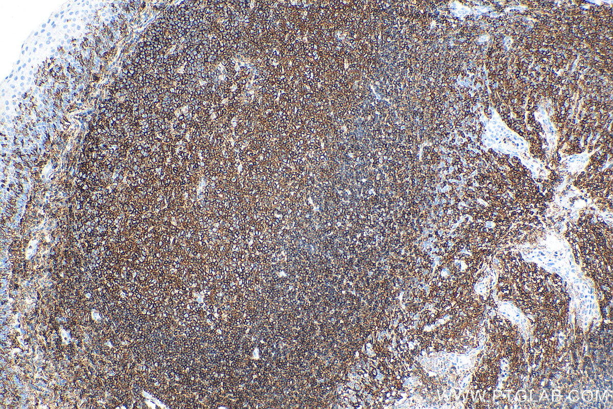 IHC staining of human tonsillitis using 80297-1-RR