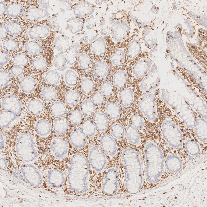IHC staining of human colorectal cancer using 80297-1-RR IHC staining of human colorectal cancer using 80297-1-RR