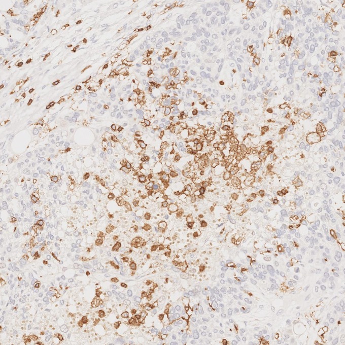 IHC staining of human ovary cancer using 80297-1-RR IHC staining of human ovary cancer using 80297-1-RR