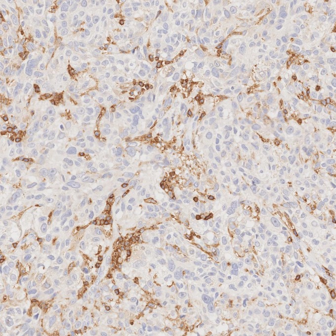 IHC staining of human malignant melanoma using 80297-1-RR IHC staining of human malignant melanoma using 80297-1-RR