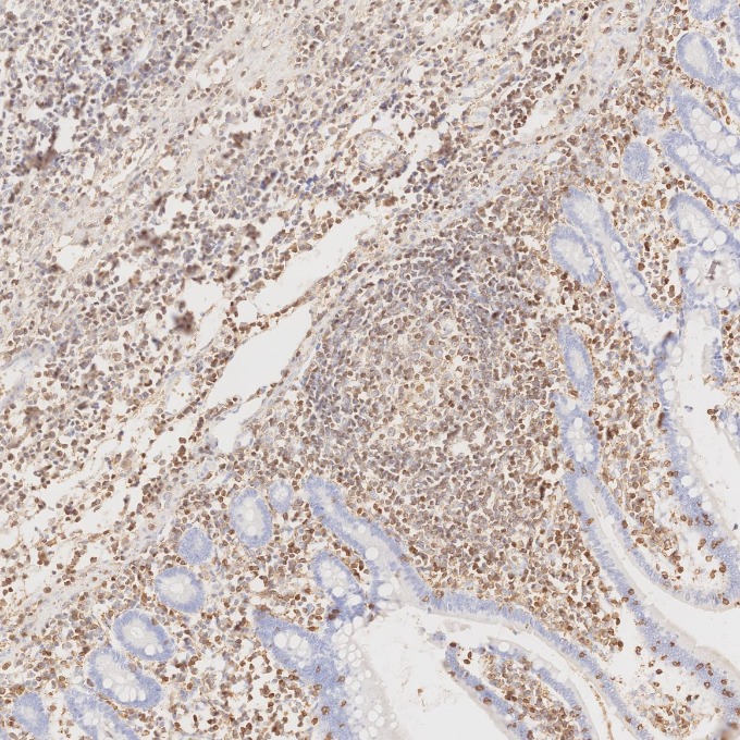 IHC staining of human lymphoma using 80297-1-RR IHC staining of human lymphoma using 80297-1-RR