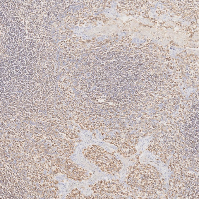 IHC staining of human tonsillitis using 80297-1-RR IHC staining of human tonsillitis using 80297-1-RR