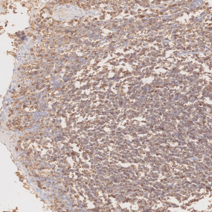 IHC staining of human tonsillitis using 80297-1-RR IHC staining of human tonsillitis using 80297-1-RR