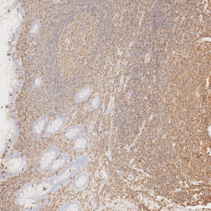 IHC staining of human appendicitis using 80297-1-RR IHC staining of human appendicitis using 80297-1-RR
