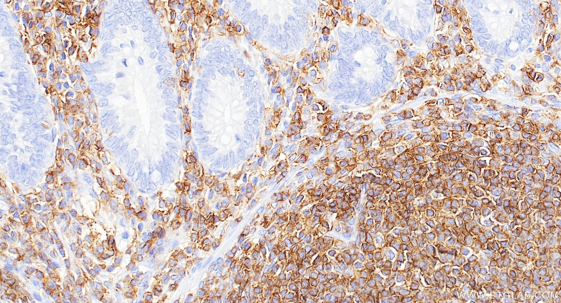 IHC staining of human appendicitis using 84405-6-RR (same clone as 84405-6-PBS)