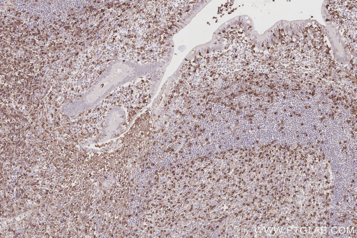 IHC staining of human appendicitis using 65150-1-Ig