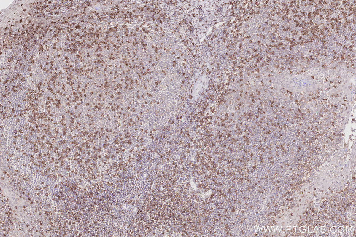 IHC staining of human tonsillitis using 65150-1-Ig