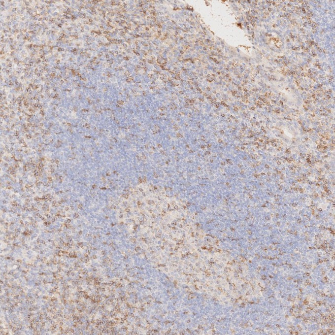 IHC staining of human appendicitis using 65150-1-Ig IHC staining of human appendicitis using 65150-1-Ig