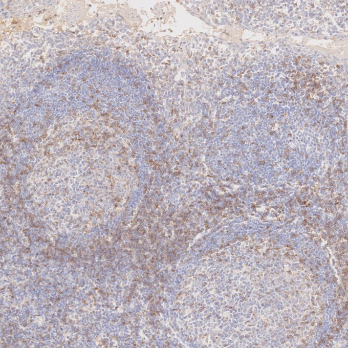 IHC staining of human tonsillitis using 65150-1-Ig IHC staining of human tonsillitis using 65150-1-Ig