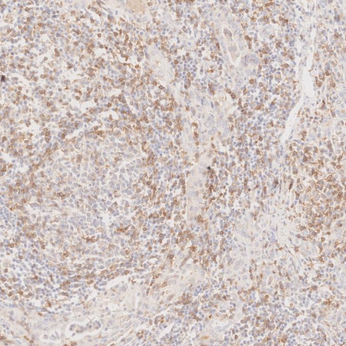 IHC staining of human lymphoma using 65150-1-Ig IHC staining of human lymphoma using 65150-1-Ig