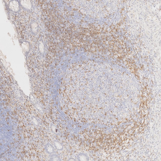 IHC staining of human appendicitis using 65150-1-Ig IHC staining of human appendicitis using 65150-1-Ig